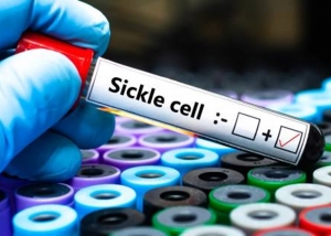 Groundbreaking Gene Therapy for Sickle Cell Disease to be Offered on the NHS